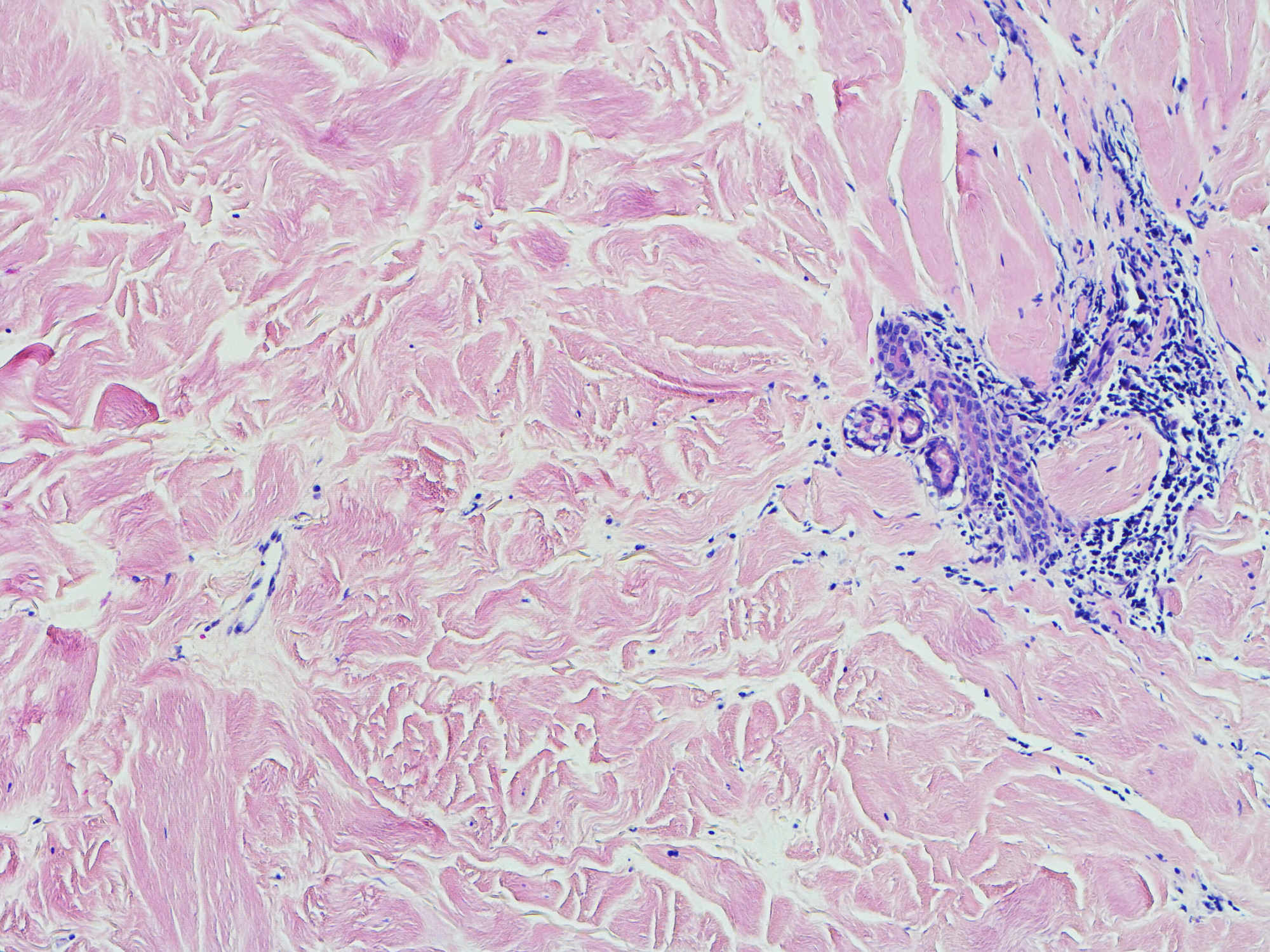 morphea histopathology