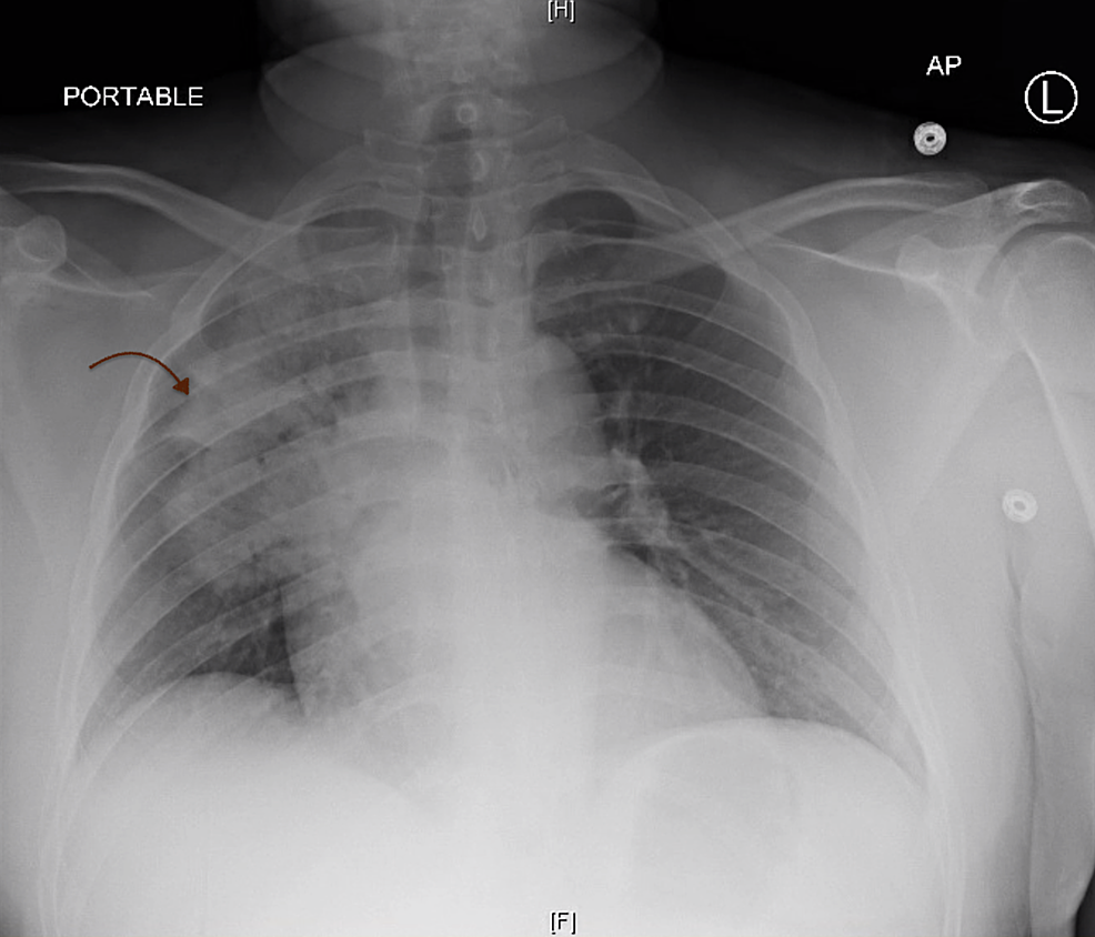 Cureus A Rare Presentation of Coronavirus Disease 2019 (COVID19