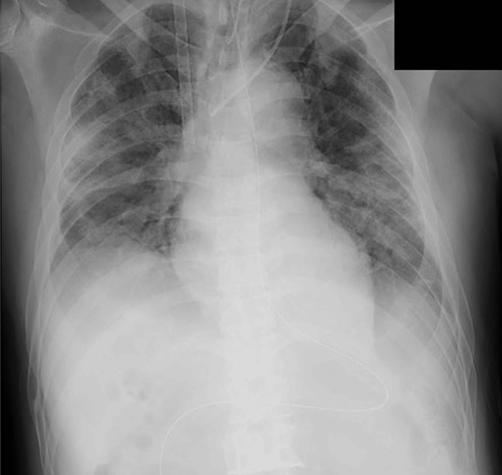 Chest-radiography-after-cannulation