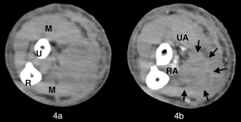 Computed-tomography-(CT)-of-the-right-upper-extremity