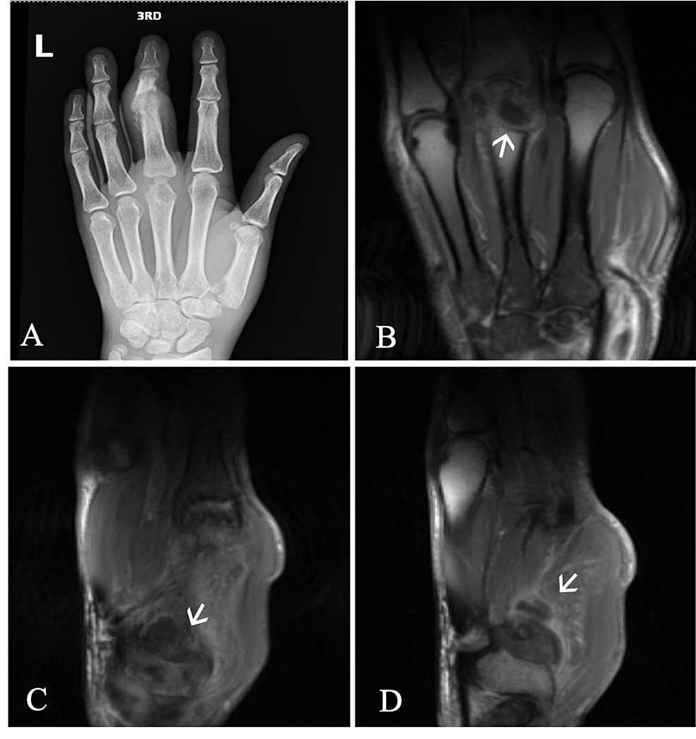 Left-hand-imaging-demonstrates-multiple-areas-concerning-for-infectious-and-inflammatory-arthritis,-tenosynovitis,-tophus,-intraosseous-abscess,-and-osteomyelitis.