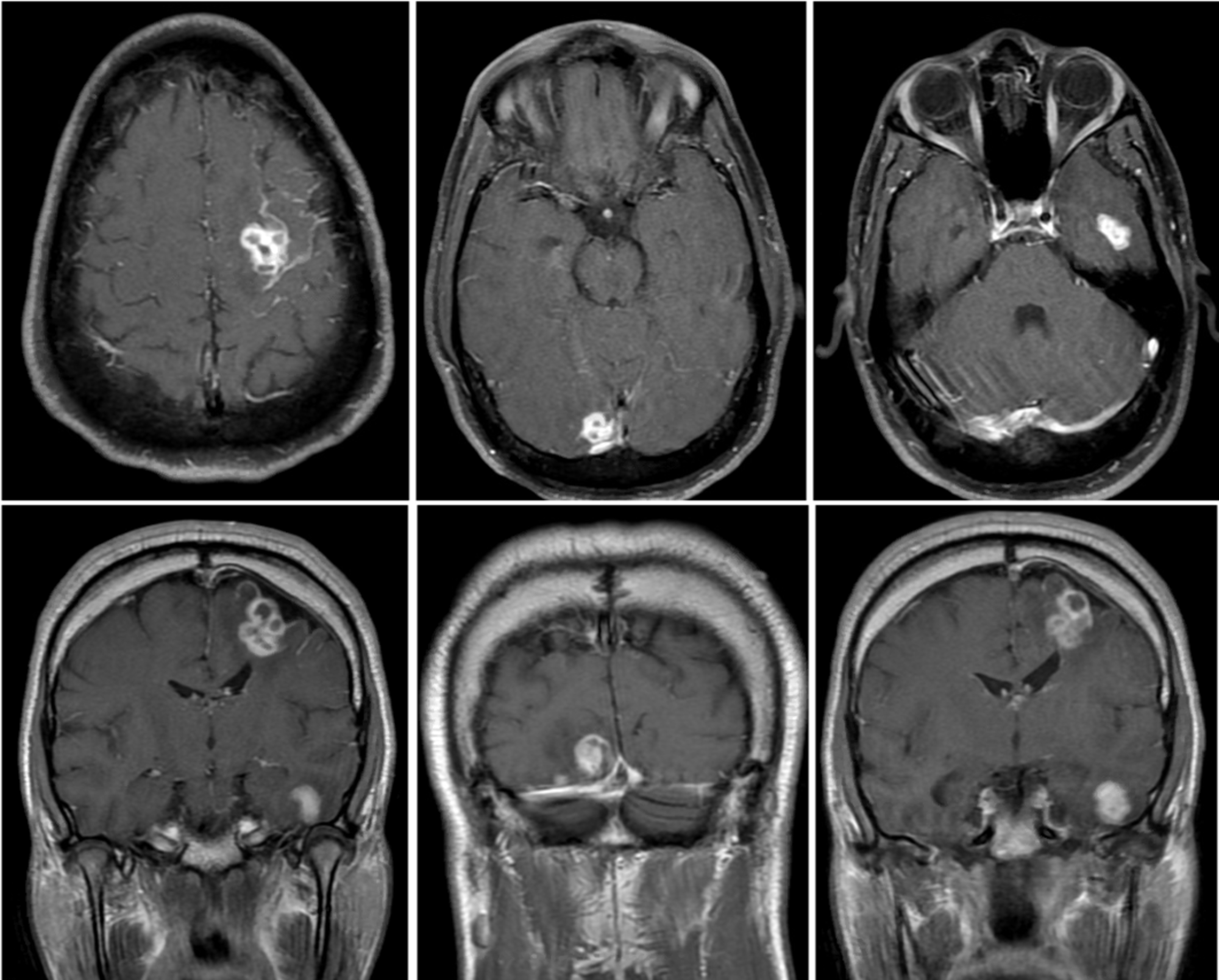 Cureus Disseminated Sporotrichosis With Brain Abscesses in an HIV