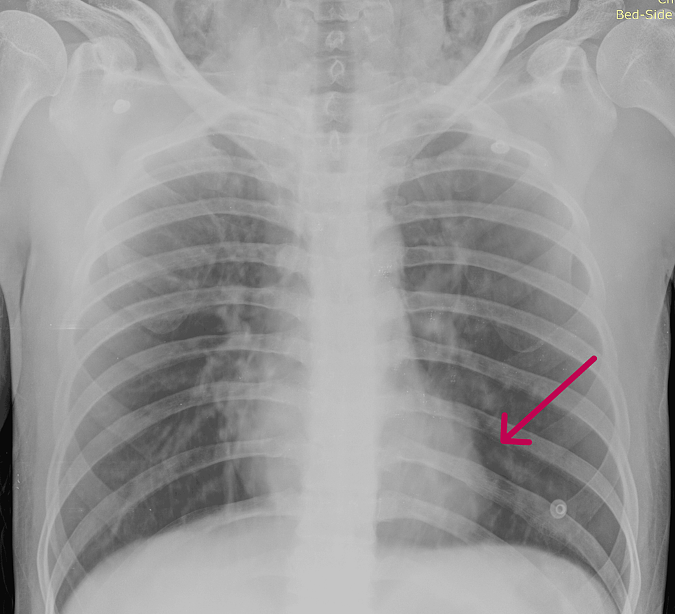 Spontaneous Pneumomediastinum in a Patient With Undiagnosed Ankylosing