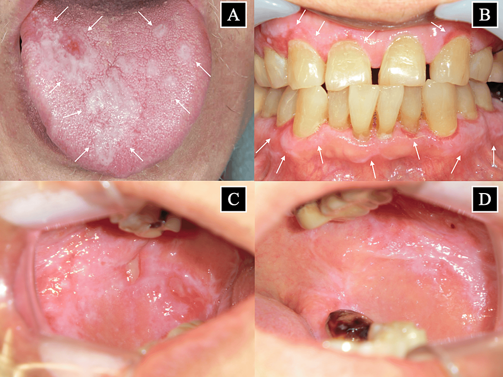 Poprawa stanu liszaja płaskiego jamy ustnej po leczeniu periodontologicznym u pacjenta ze stłuszczeniową chorobą wątroby związaną z dysregulacją metaboliczną: opis przypadku.