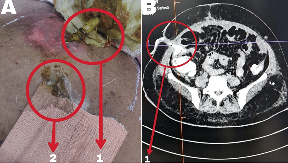 Challenges and successes in the treatment of enterocutaneous fistulas: A case report of complex surgical interventions and multidisciplinary care