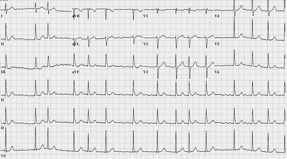 Electrocardiogram-showing-persistent-atrial-fibrillation-with-improved-heart-rate