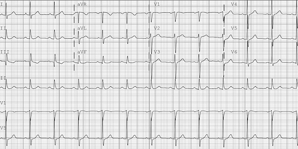 Electrocardiogram-showing-normal-sinus-rhythm-after-spontaneous-cardioversion