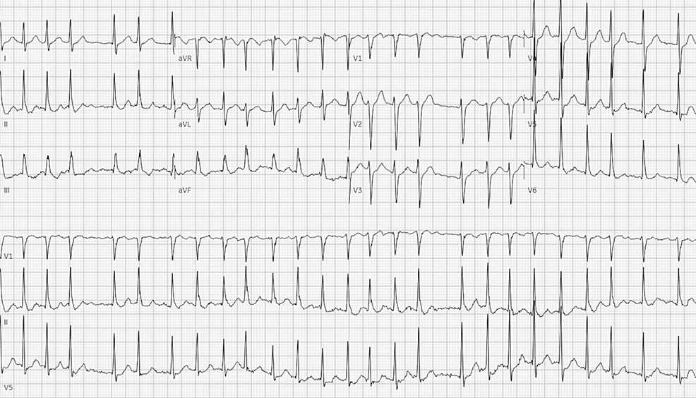 Electrocardiogram-showing-atrial-fibrillation-with-rapid-ventricular-response