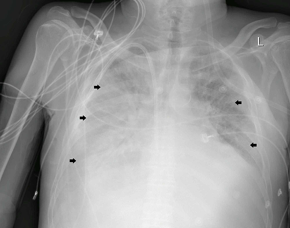 portable-chest-x-ray-(24-hours-after-admission)-showing-bilateral-patchy-lower-lobe-predominant-airspace-opacification-(Black-Arrows).