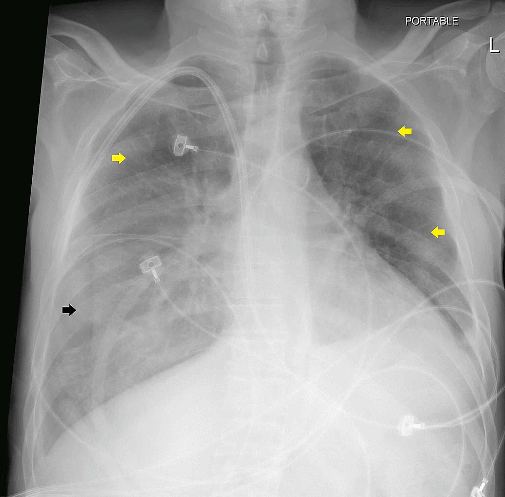 Cureus | A Hemodialysis Patient with Severe COVID-19 Pneumonia