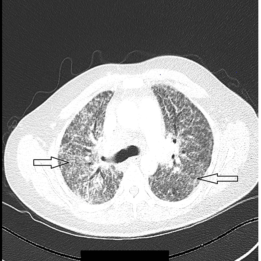 Sarcoidosis as a Great Mimicker: Diagnostic Challenges in a