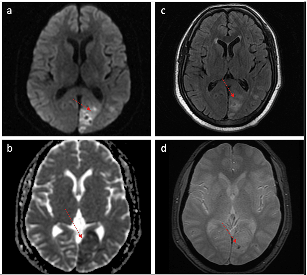 MRI-brain