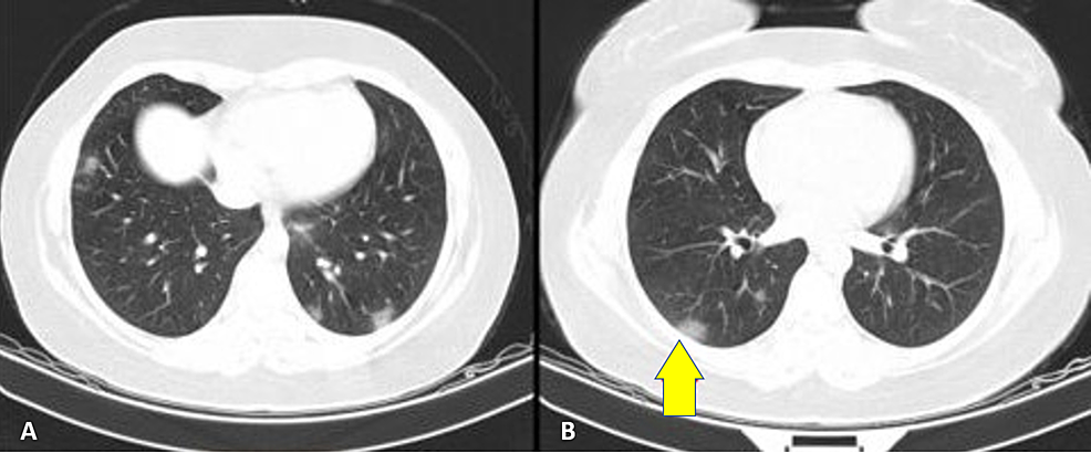 A-lung-computed-tomography-scan-showing-small-diffuse-patchy-consolidation-(A)-and-bilateral-ground-glass-opacities-(B),-characteristic-of-COVID-19-infection