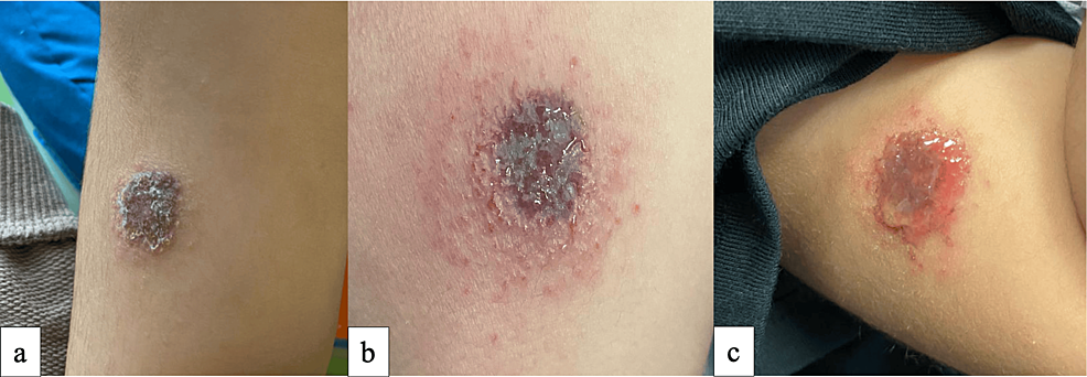 Unusual Appearance of Meyerson Phenomenon Arising From a Congenital Melanocytic  Nevus: Case Report and Literature Review
