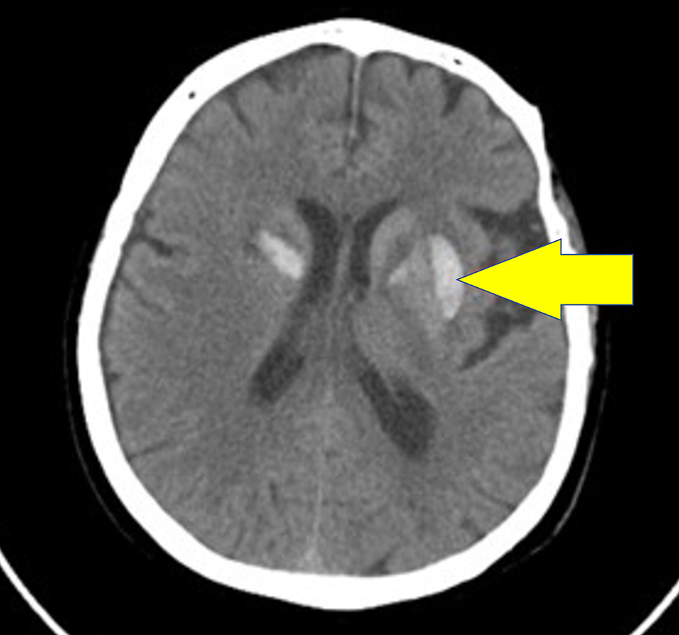 A-computed-tomography-scan-of-the-head-that-shows-acute-to-subacute-changes-evident-of-bilateral-basal-ganglia-hyperdensity-matching-with-a-subacute-hemorrhagic-event