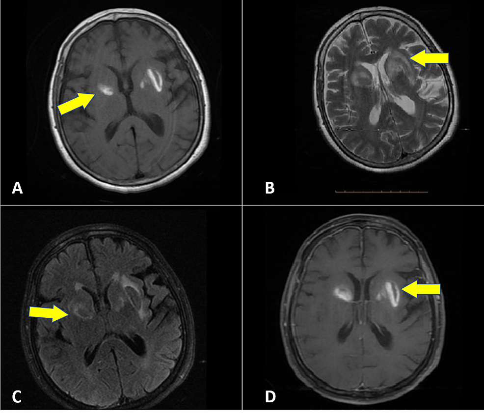 Magnetic-resonance-imaging-T1-(A),-T2-(B),-fluid-attenuated-inversion-recovery-(C),-and-gadolinium+-(D)-showing-the-signal-change-in-bilateral-basal-ganglia-matching-a-bleeding-event