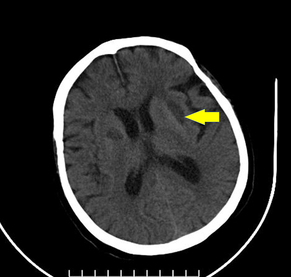 Follow-up-brain-computed-tomography-scan-showing-hypodensity-after-absorption-of-bleeding-in-the-basal-ganglia