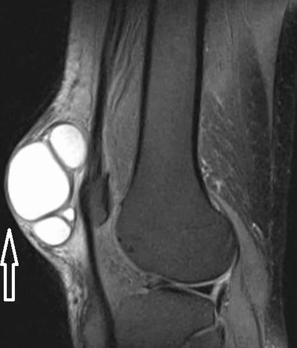 Cureus Unwanted Diagnosis of a Subcutaneous Swelling