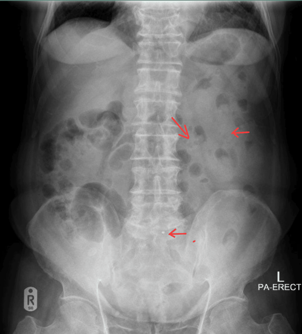 Cureus | Atypical Presentation and Diagnostic Challenges of Appendicitis in  an 85-Year-Old Male: A Case Report