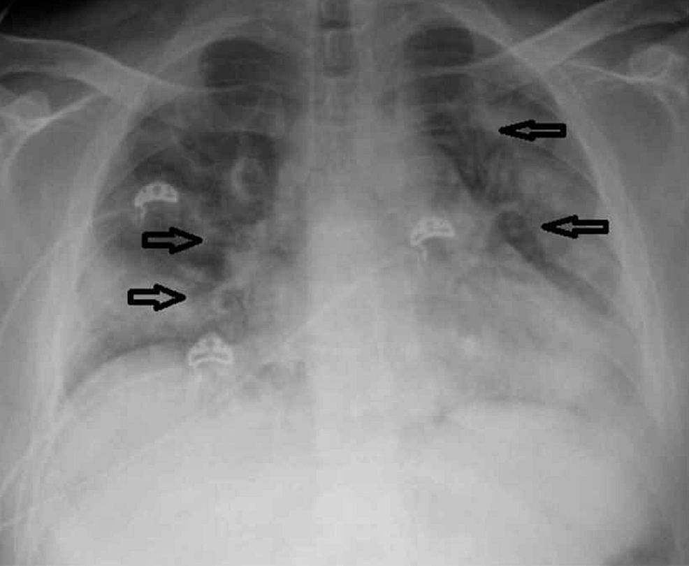 Chest-X-ray-portable-revealed-cardiomegaly-with-bilateral-lung-infiltrates