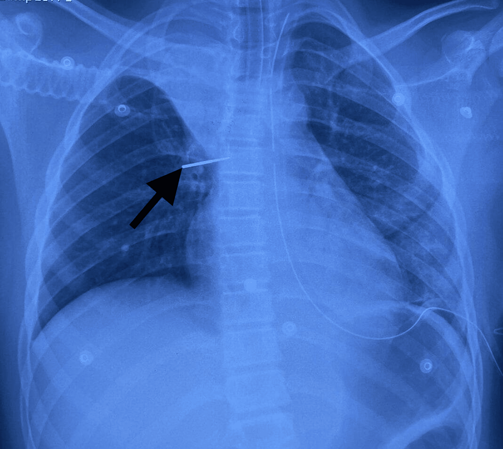 Chest-X-ray-showing-a-right-perihilar-FB-(16/05/2024)-