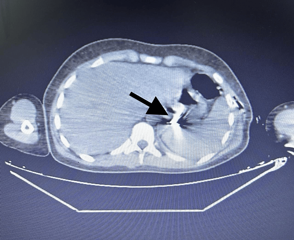 Abdominopelvic-CT-scan-showing-a-FB-in-the-gastric-lumen