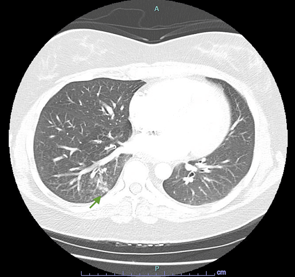 Ground-glass-opacification-in-the-right-lower-lobe-associated-with-PVT-possibly-representing-localized-pulmonary-edema.-