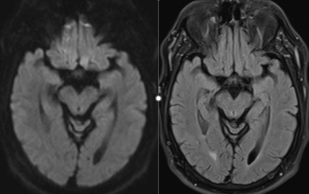 MRI-DWI-(right)-and-FLAIR-(left)-sequences-of-the-midbrain-showed-no-abnormality