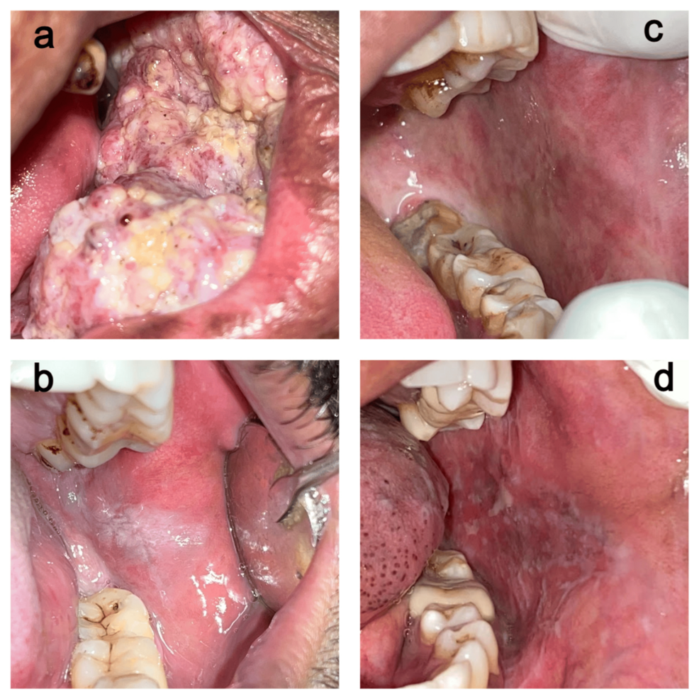 oral glutathione reddit Comparative Assessment of Lipid Peroxidase in Oral Cancer and Oral  Potentially Malignant Disorders