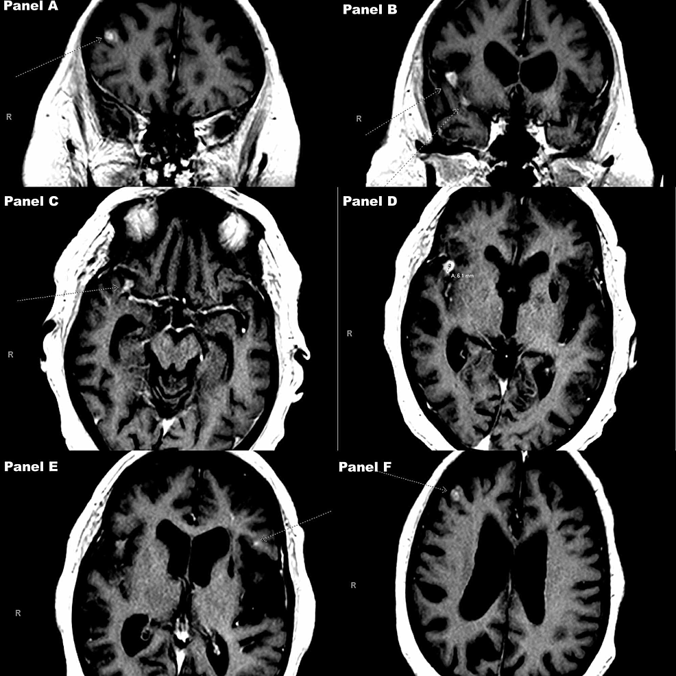 Cureus, Brainstem and Spinal Arachnoiditis Ossificans Associated With  Neurocysticercosis: A Case Report