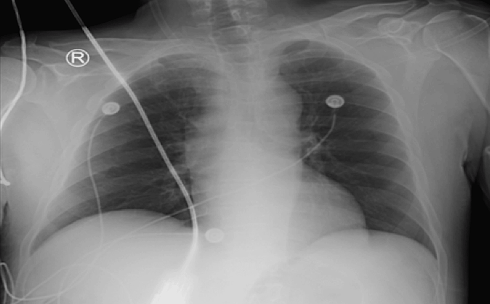 Admission-chest-radiograph-demonstrating-no-abnormal-findings Admission-chest-radiograph-demonstrating-no-abnormal-findings