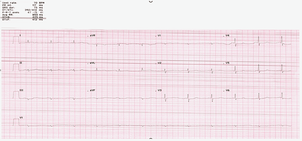 EKG-showing-low-voltage,-particularly-over-the-limb-leads,-with-normal-sinus-rhythm-and-left-axis-deviation EKG-showing-low-voltage,-particularly-over-the-limb-leads,-with-normal-sinus-rhythm-and-left-axis-deviation