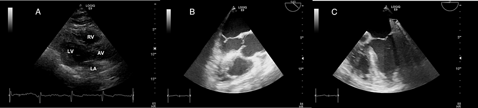 Admission-echocardiography-images:-(A)-Four-chamber-view-from-transthoracic-echocardiography-showing-no-valve-vegetation.-(B)-Aortic-view-from-transesophageal-echocardiography,-revealing-no-vegetation-on-the-aortic-valve.-(C)-Four-chamber-view-at-0-degrees-from-transesophageal-echocardiography,-showing-no-vegetation-on-the-mitral-valve Admission-echocardiography-images:-(A)-Four-chamber-view-from-transthoracic-echocardiography-showing-no-valve-vegetation.-(B)-Aortic-view-from-transesophageal-echocardiography,-revealing-no-vegetation-on-the-aortic-valve.-(C)-Four-chamber-view-at-0-degrees-from-transesophageal-echocardiography,-showing-no-vegetation-on-the-mitral-valve
