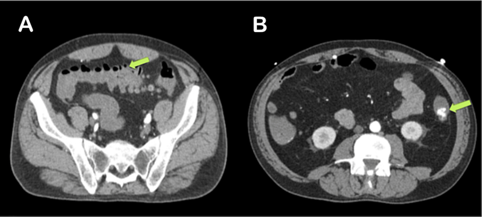 Abdominal-CT-with-contrast-demonstrating-(A)-diverticulosis-without-signs-of-diverticulitis-and-no-evidence-of-bowel-obstruction-and-(B)-contrast-extravasation-within-the-lumen-of-the-descending-colon,-indicative-of-a-lower-gastrointestinal-bleed Abdominal-CT-with-contrast-demonstrating-(A)-diverticulosis-without-signs-of-diverticulitis-and-no-evidence-of-bowel-obstruction-and-(B)-contrast-extravasation-within-the-lumen-of-the-descending-colon,-indicative-of-a-lower-gastrointestinal-bleed