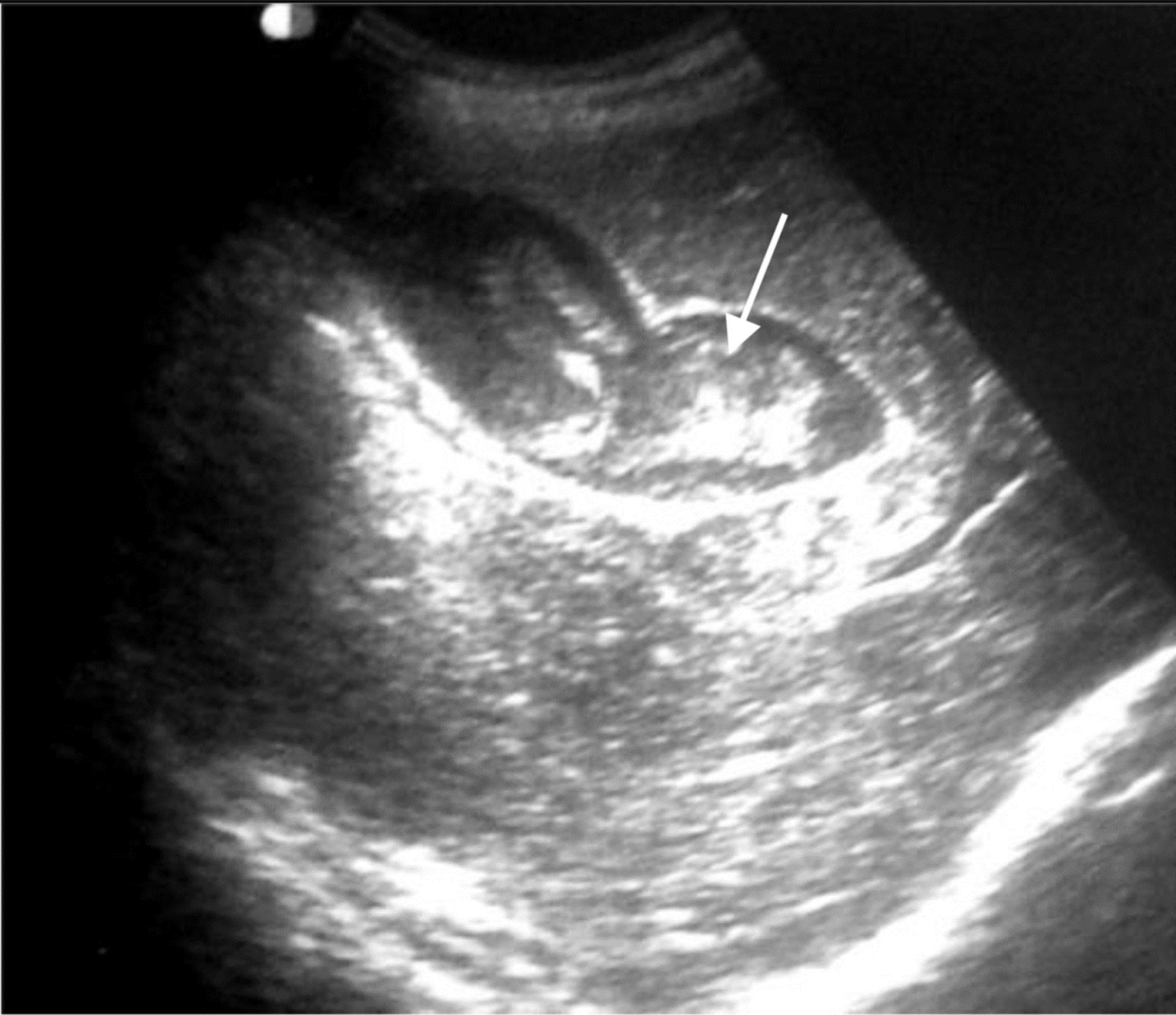 Cureus | Post-Blunt Traumatic Hemobilia From Pseudoaneurysm ...