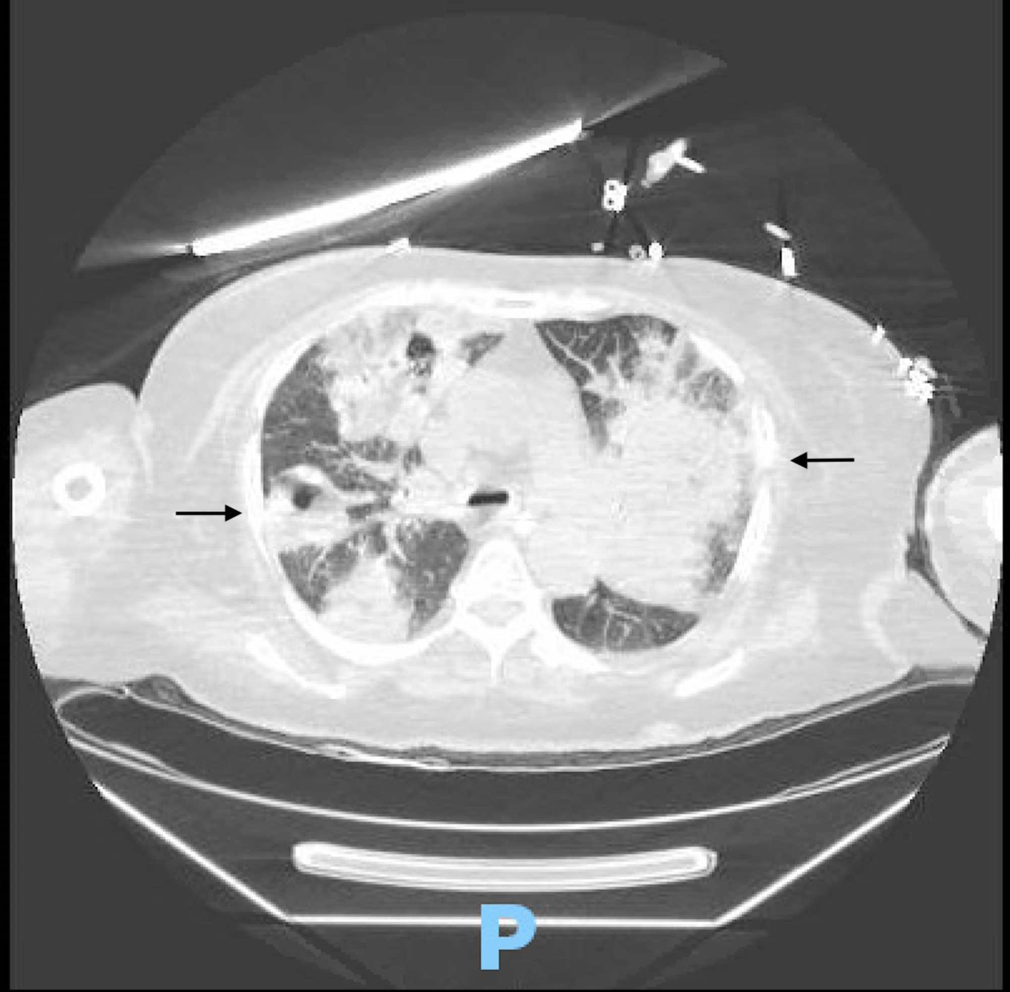 Cureus Aspergillus And Rhizopus Fungal Coinfection In A Patient With Multiple Myeloma