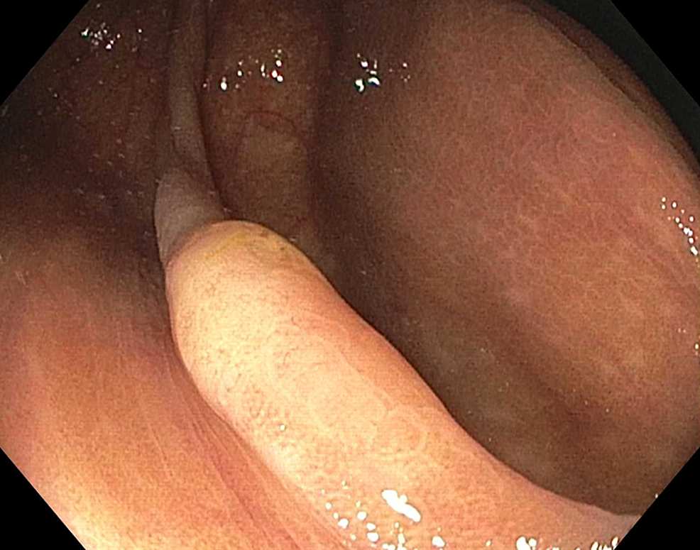 The Wick Sign After Cold Snare Polypectomy: A Case Report | Cureus