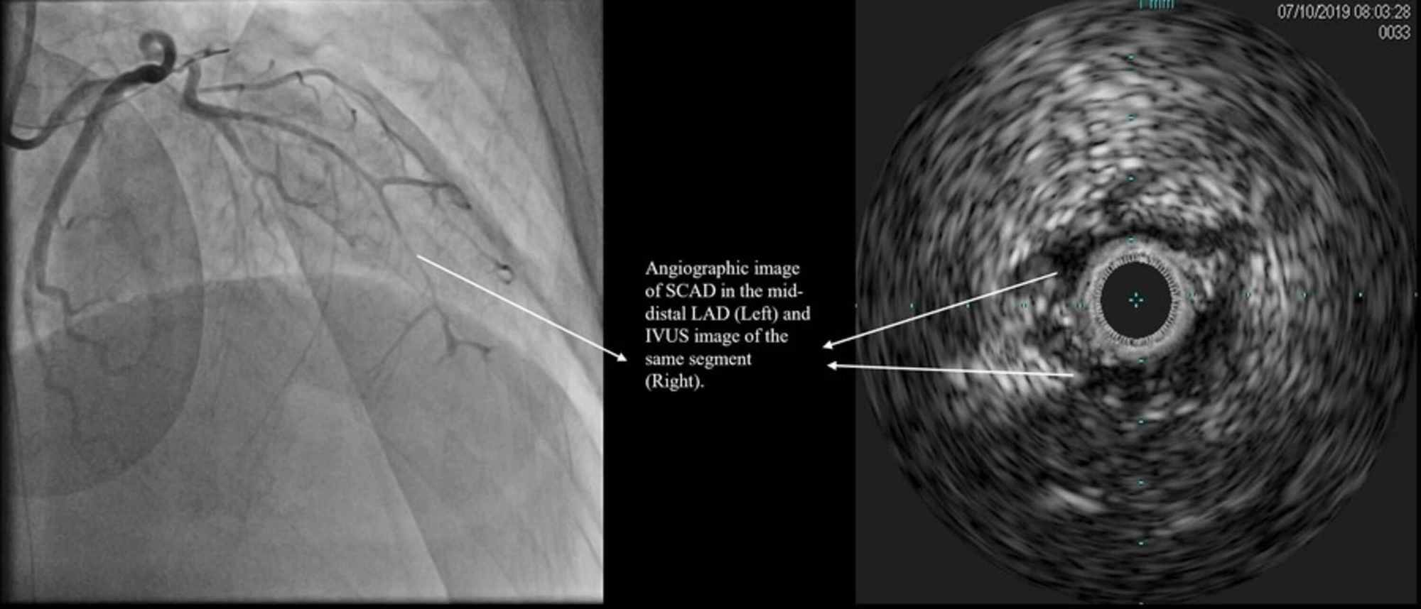 cureus-acute-myocardial-infarction-due-to-spontaneous-coronary-artery