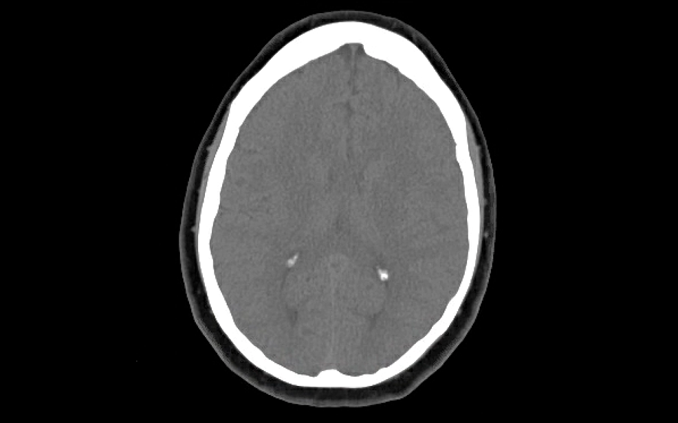 CT-head-without-contrast