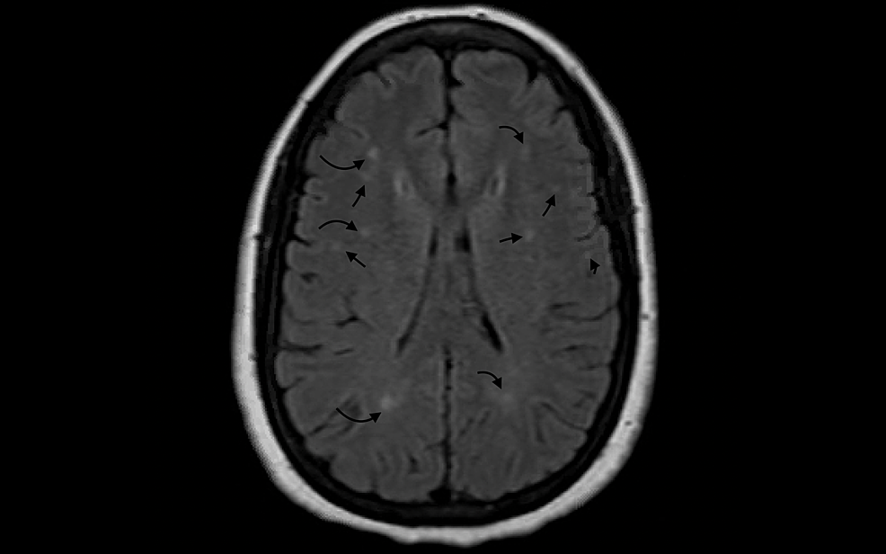 MRI-of-the-brain