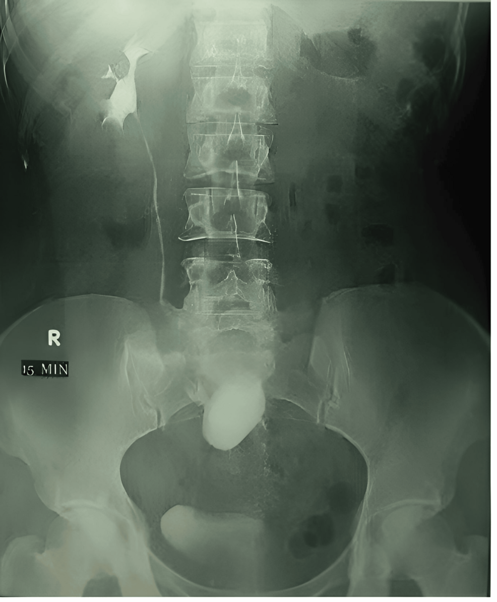 Transperitoneal Laparoscopic Pyelolithotomy in Pelvic Ectopic Kidneys ...