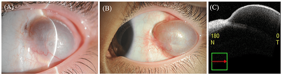 a-case-of-conjunctival-cyst-required-removal-six-months-after