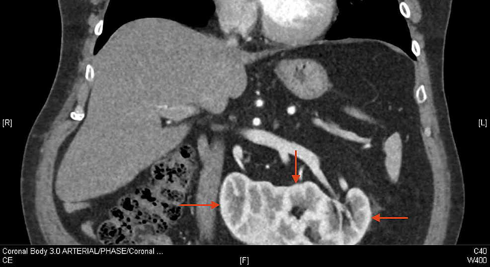 Cureus Nephroureterectomy of RighttoLeft Crossed Fused Renal Ectopia with Urothelial Carcinoma