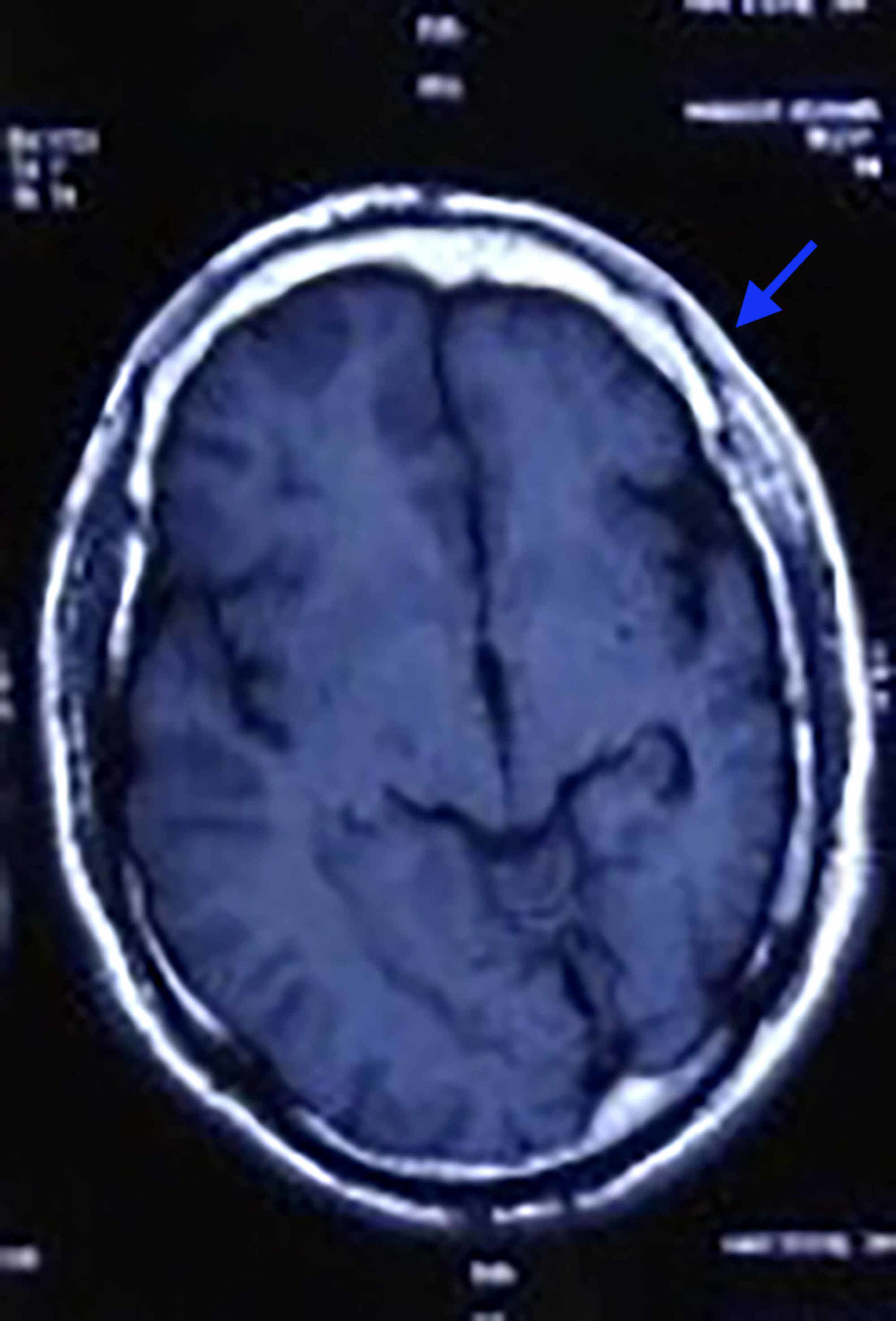 Cureus Hemiconvulsion Hemiplegia Epilepsy Syndrome In Adult With