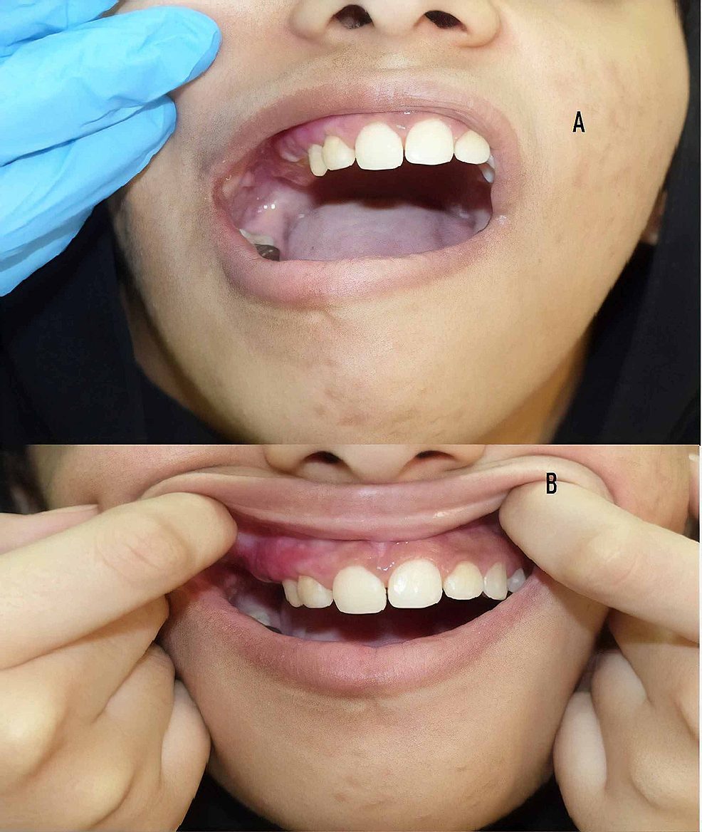 (A)-Gingival-hypertrophy-over-the-right-side-and-(B)-missing-and-irregular-spacing-of-the-teeth-on-the-same-side.
