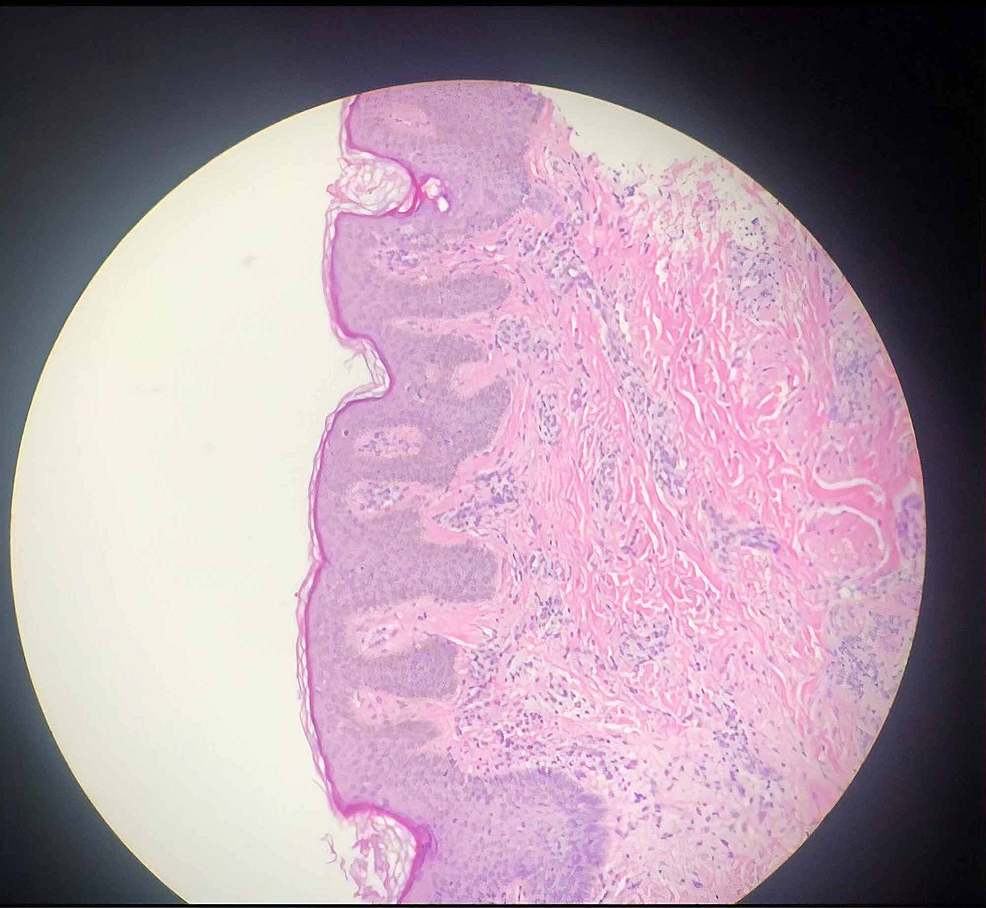 A-histopathological-appearance-of-the-hyperpigmented-patch-on-H&E-staining-(high-power)-and-hypomelanosis-with-elongation-of-rete-ridges,-suggestive-of-Becker’s-nevus.