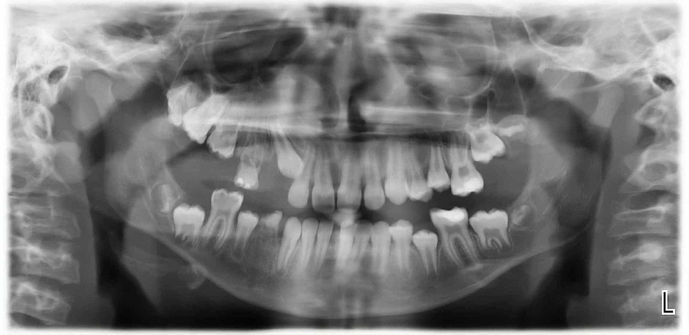 A-dental-radiograph-demonstrating-hyperplasia-of-the-right-maxillary-alveolus-and-basal-bone-with-missing-teeth.
