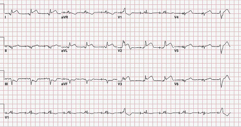 Rare and Fascinating Case of ST-Elevation Myocardial Infarction ...