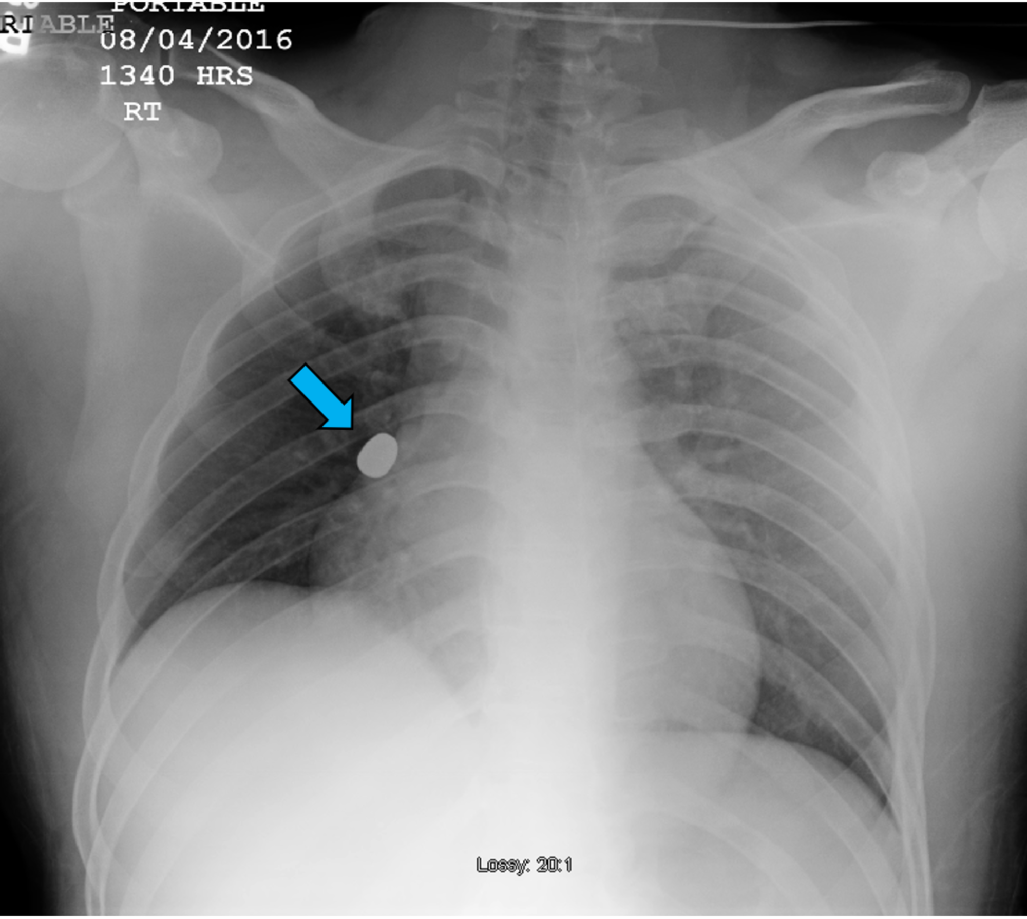 Xray Scans A Supine View B Crosstable Lateral View