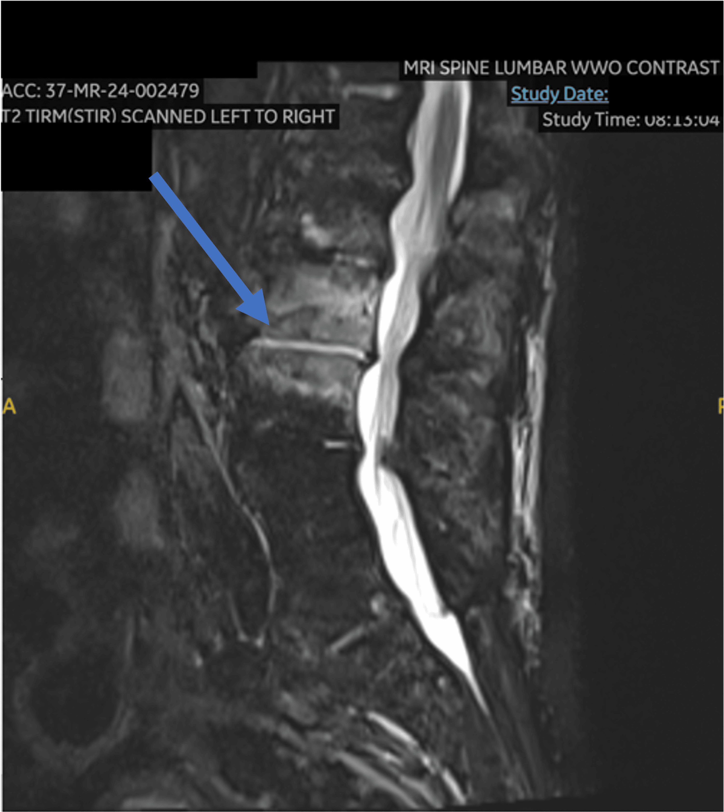 A Case Of Granulicatella Adiacens Osteomyelitis And Mitral Valve 